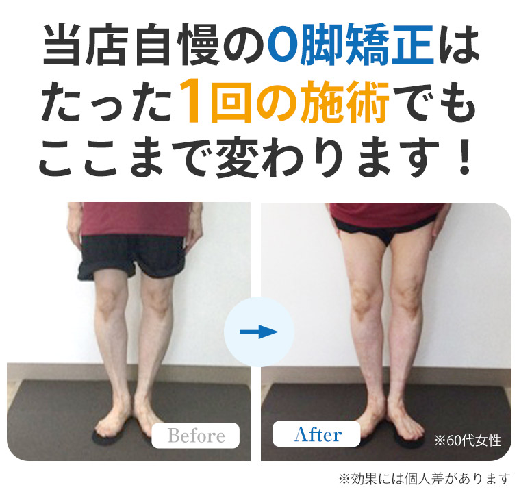 O脚BA