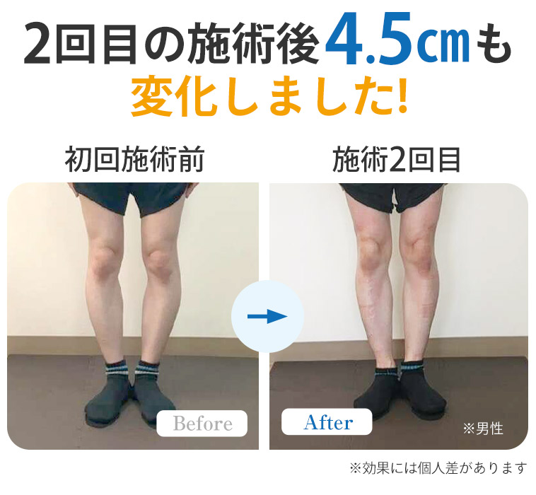 O脚ビフォーアフター2