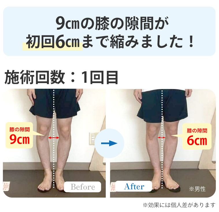 O脚BA