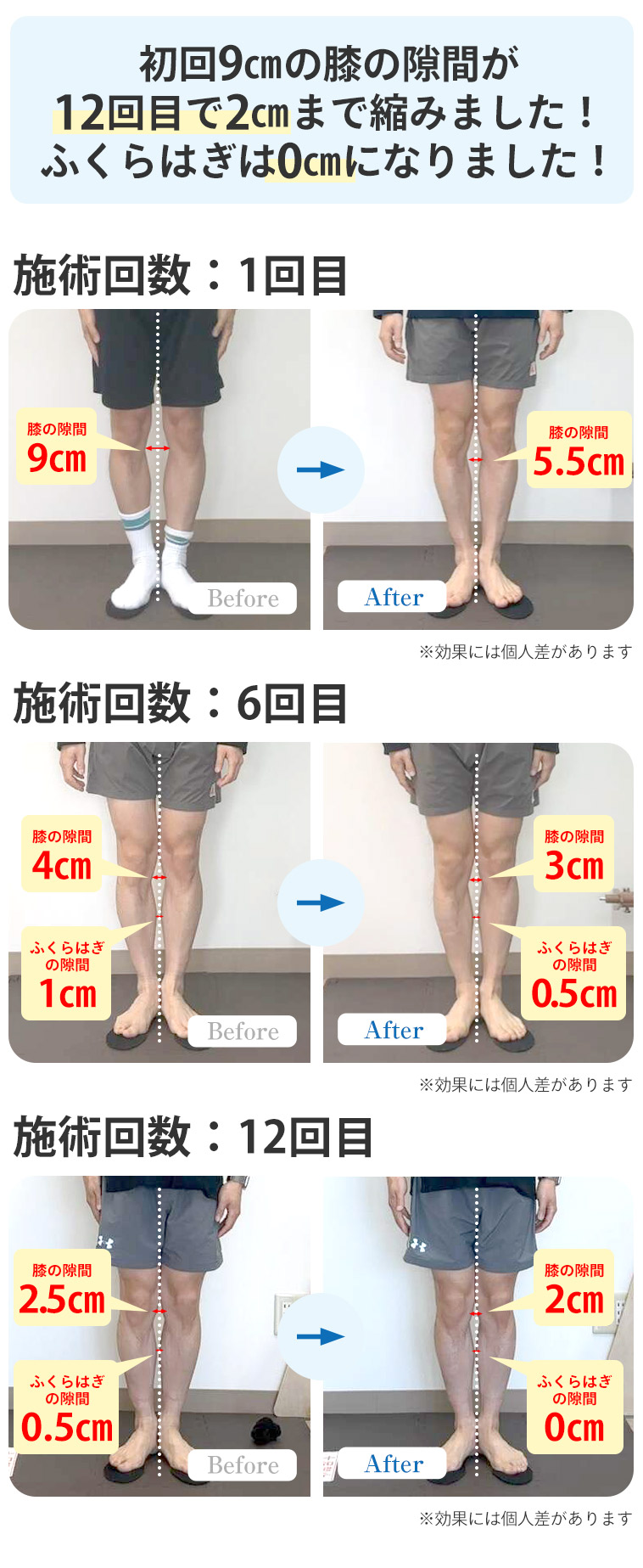 O脚BA