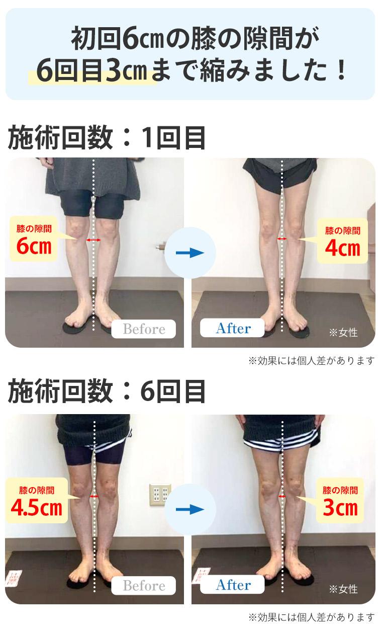 O脚BA