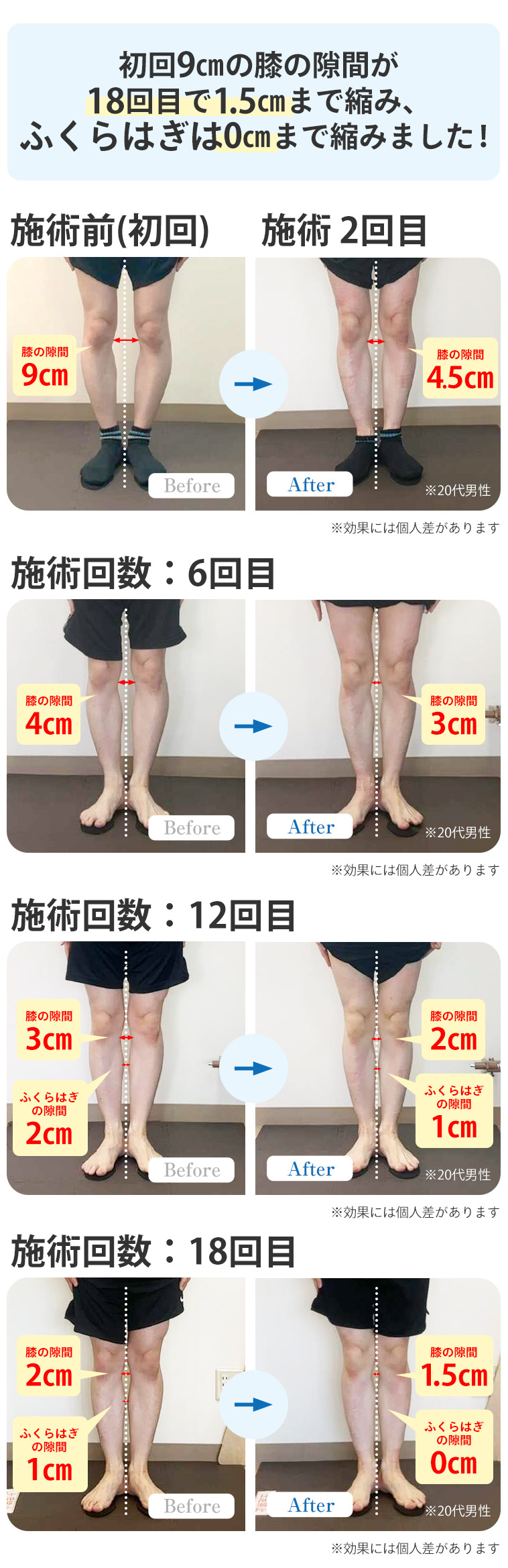O脚BA