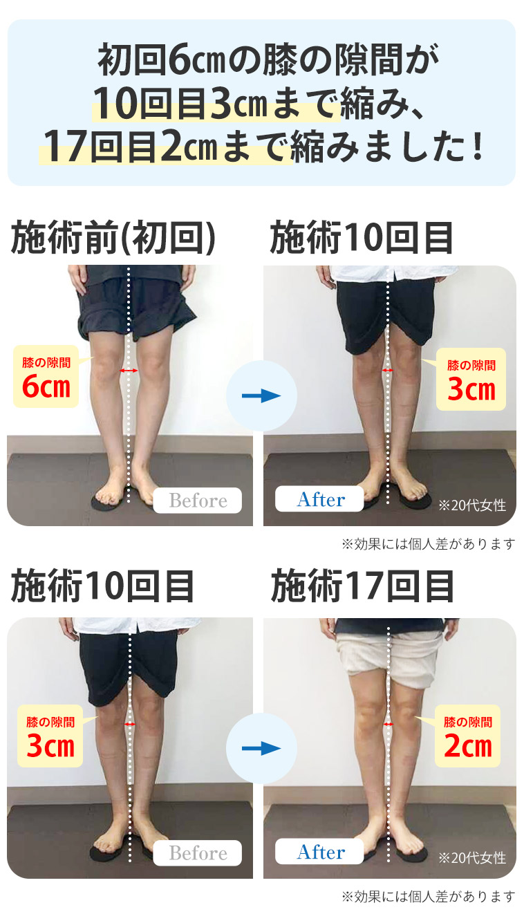 O脚BA