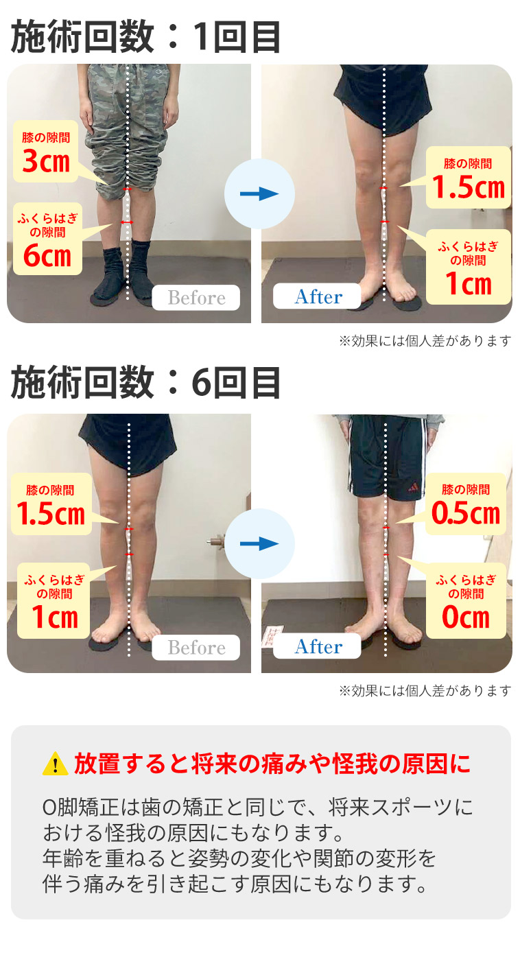 O脚BA