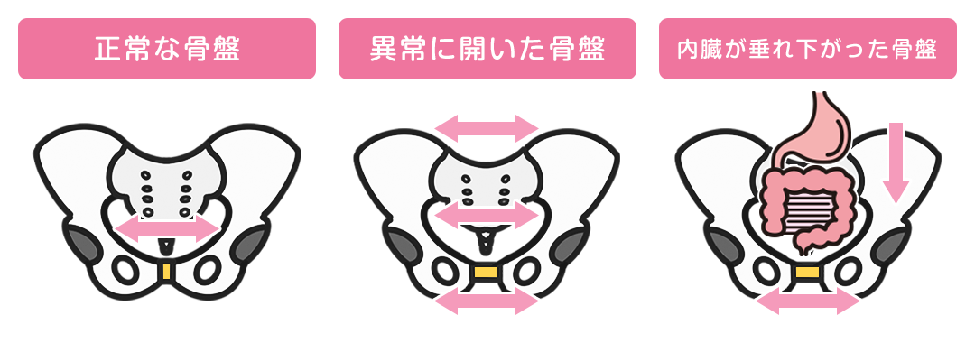 産後の骨盤矯正説明